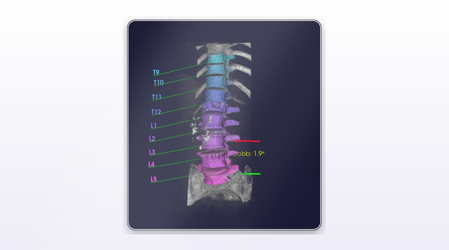 Interactive 3D spine visualisation with vertebra labels and curvature readout