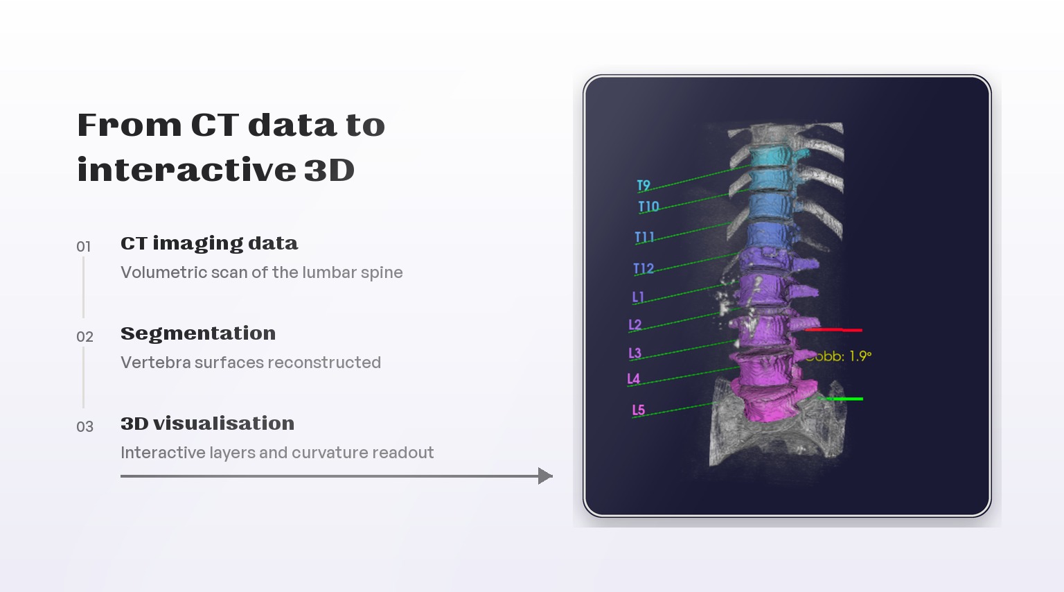 Pipeline diagram showing CT data, segmentation, and interactive 3D visualisation alongside the spine render